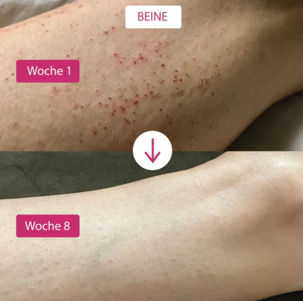 IPL Lasergerät, weiß