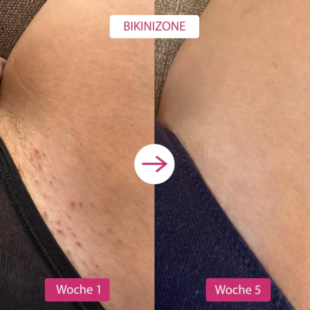 IPL Lasergerät, weiß