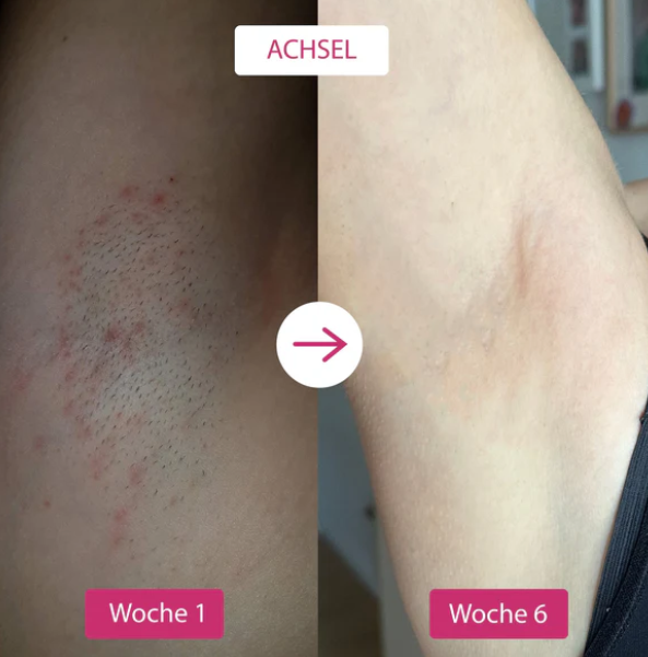 IPL Lasergerät, weiß